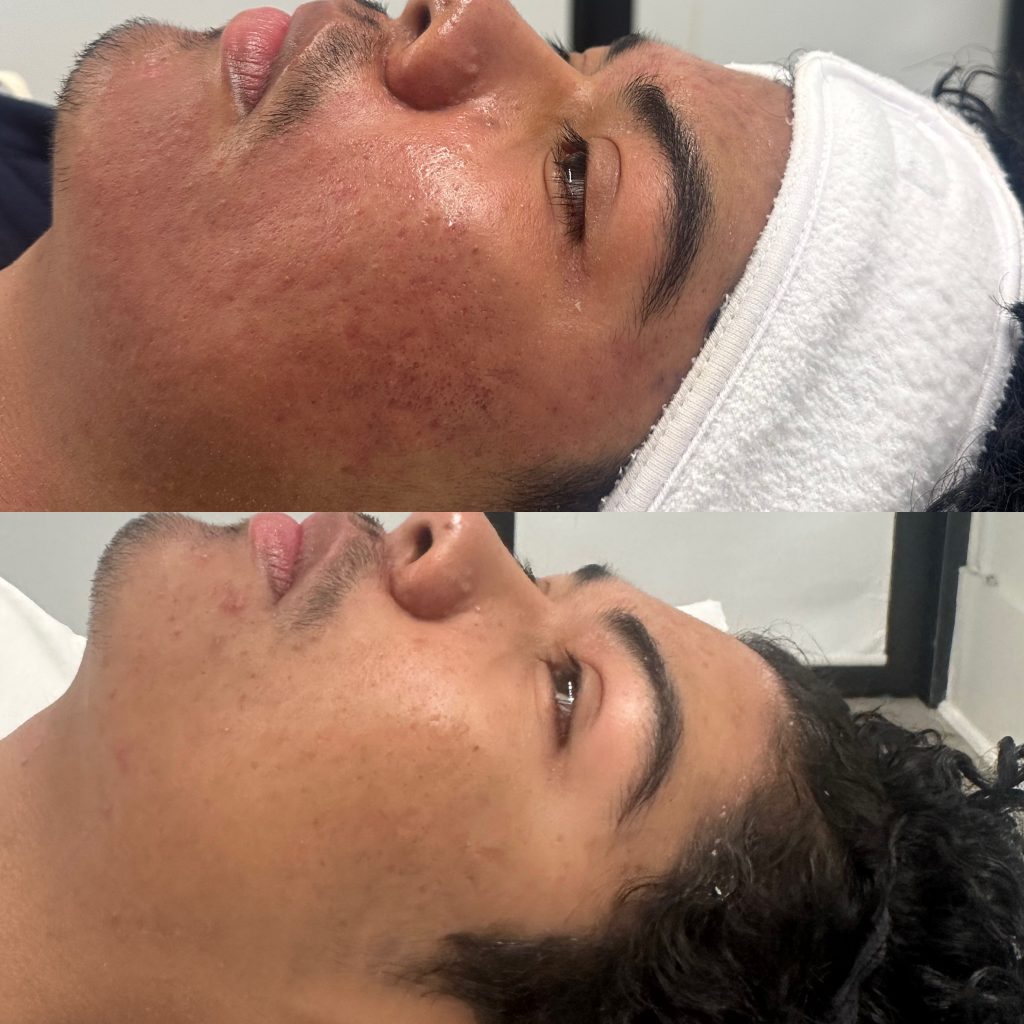 1 session microneedling before and after