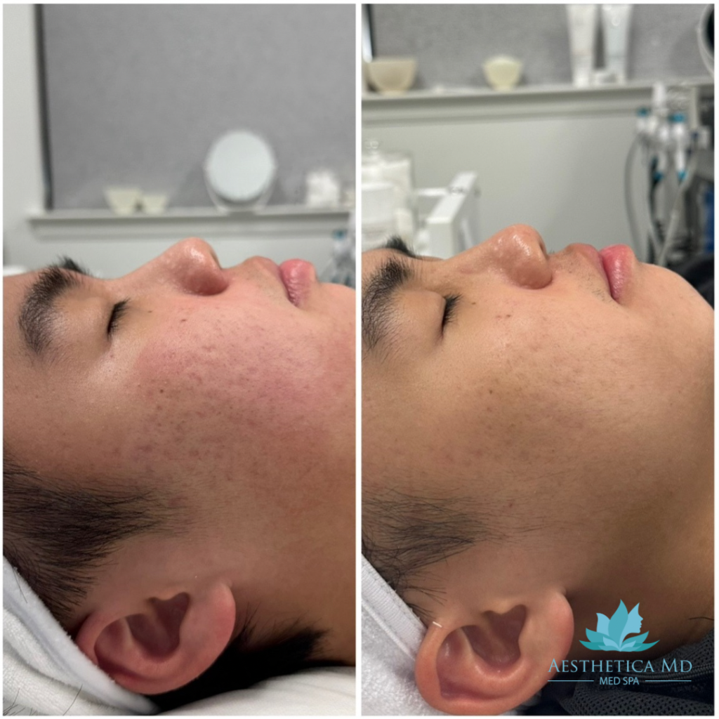 Microneedling 2 sessions