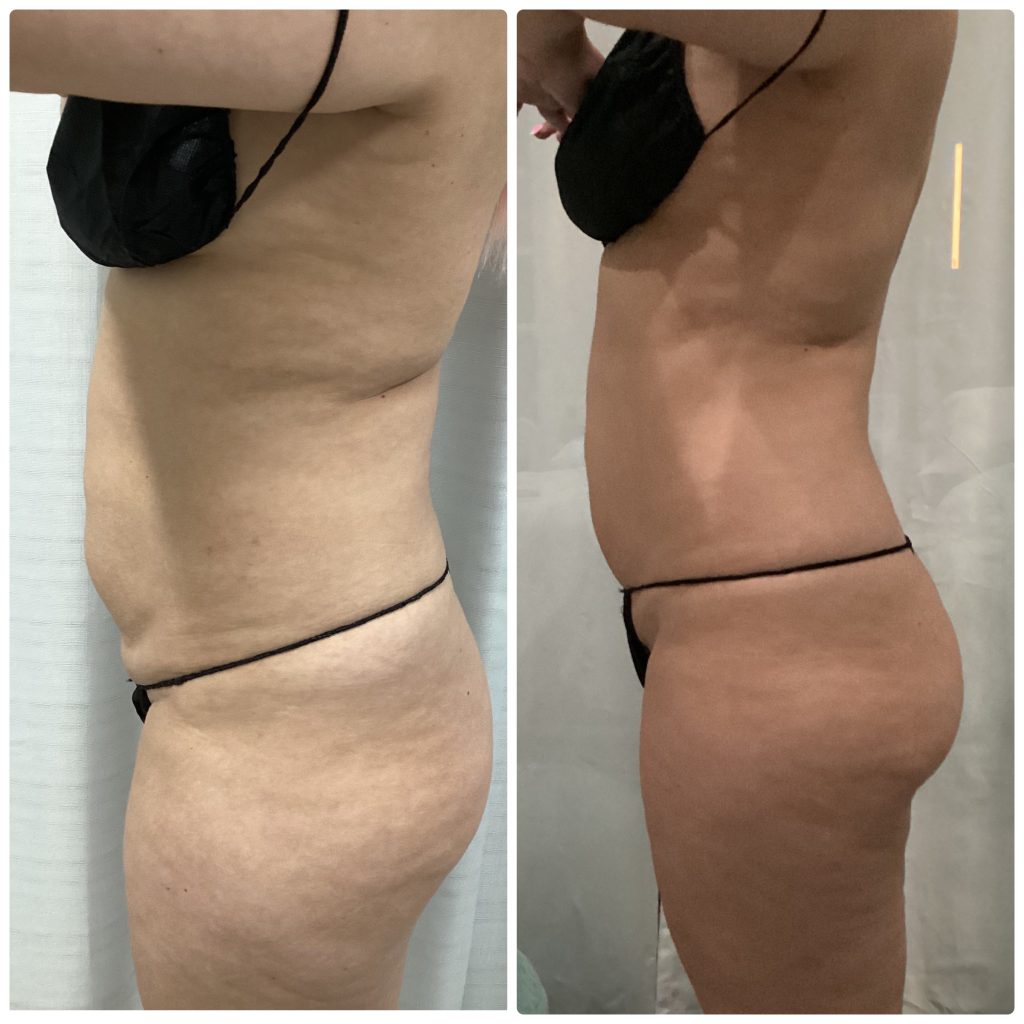 bodycontouringinstaslim 2