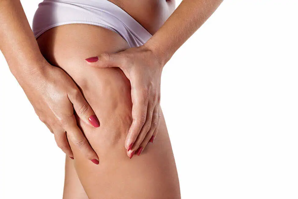 Cellulite by Cypress Wellness Aesthetics LLC in Cypress Texas 1