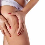 Cellulite by Cypress Wellness & Aesthetics LLC in Cypress, Texas