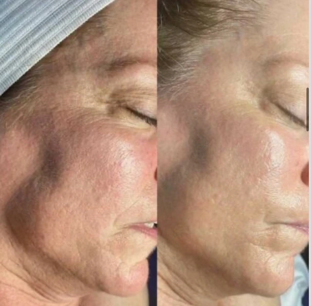 HydraFacial 5
