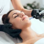 Microneedling with PRP at Aesthetica MD Med Spa in Cypress, TX