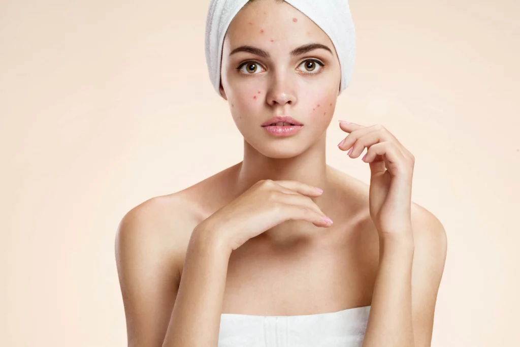 Acne Treatment 1