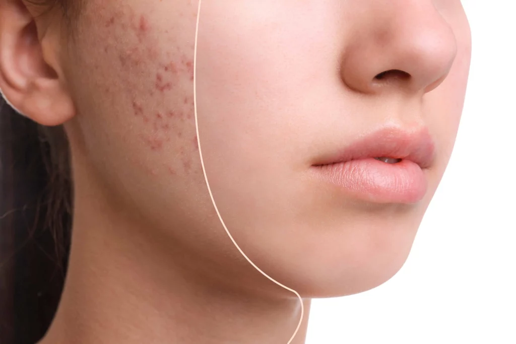 Acne Treatment 2