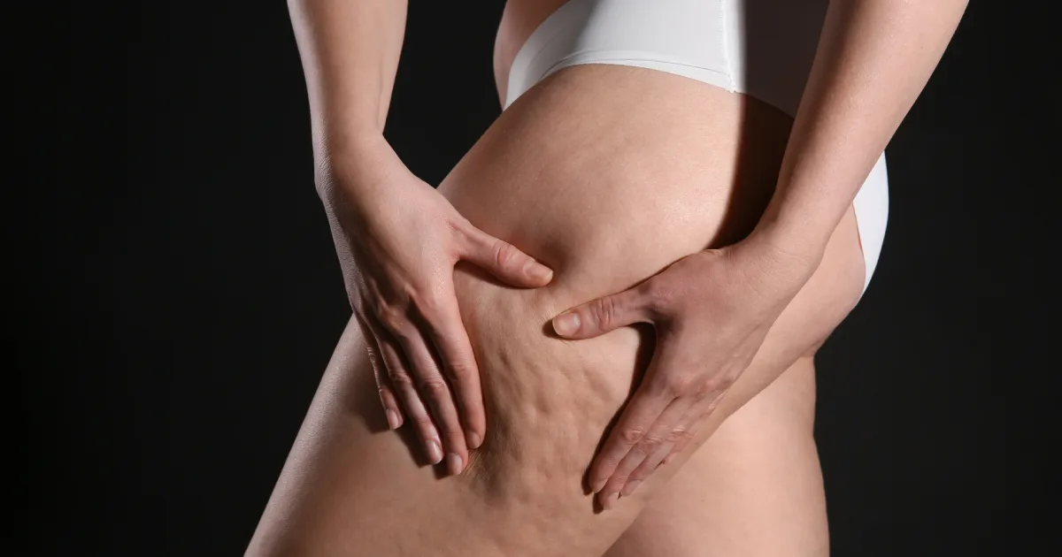 Thigh cellulite appearance before cellulite reduction treatment in Cypress, TX