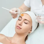 Improve Sun Damage with chemical peel