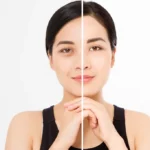 PRF/EZ Gel for Under-Eye Hollows & Dark Circles