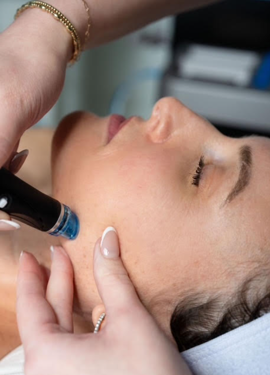 microneedling