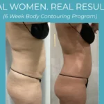 Body Contouring treatment: Before and after treatment photo