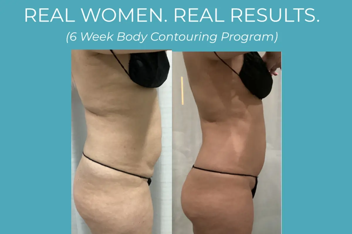post semaglutide body contouring boston Top 7 Benefits Of Semaglutide For Weight Loss & Health