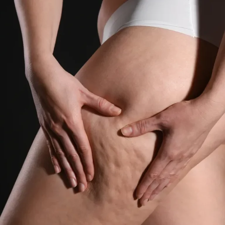Thigh cellulite appearance before cellulite reduction treatment in Cypress, TX