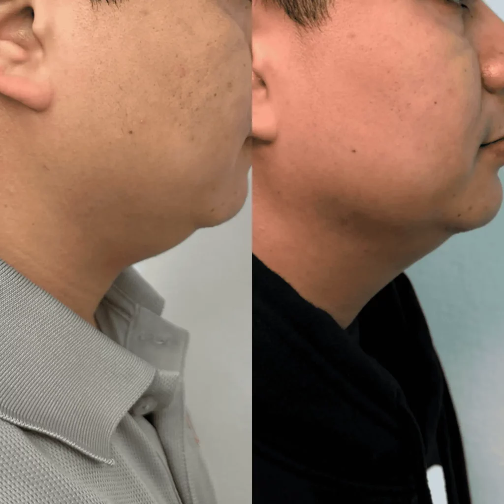 Kybella | Cypress Wellness & Aesthetics LLC