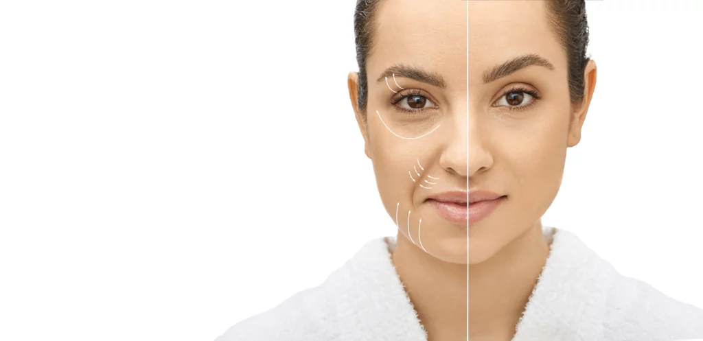Morpheus8® Treatment 1