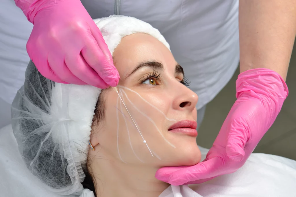 Morpheus8® Treatment 5